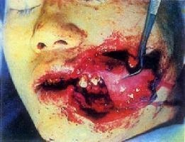 口腔颌面部软组织挫裂伤