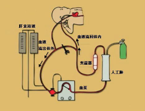  p>人工肺又名氧合器或气体交换器,是一种代替人体肺脏排出二氧化碳