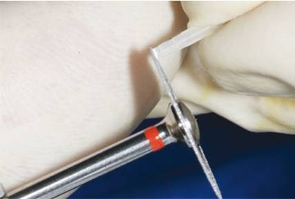  p>纤维桩是一种新型的非金属复合牙科修复材料,常与树脂核及冠修复体