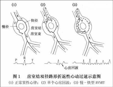 房室结折返性心动过速领域提 交心血管病学医学词条 主页》词条 科普