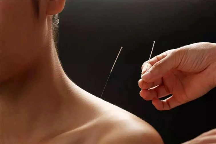 针灸（刺针来治疗疾病）_百度百科