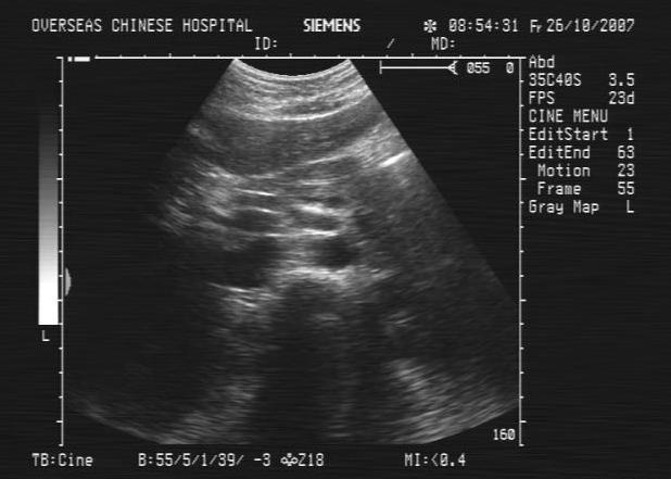 硬化性胆管炎_百度百科