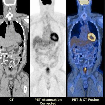 PET-CT_百度百科